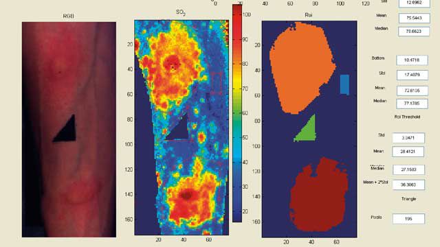 來自諾丁漢大學的高光譜圖像，通過將光線照射在組織表面并準確測量氧氣水平并生成血氧飽和度圖而得出，以方便臨床研究人員和醫(yī)生的工作。
